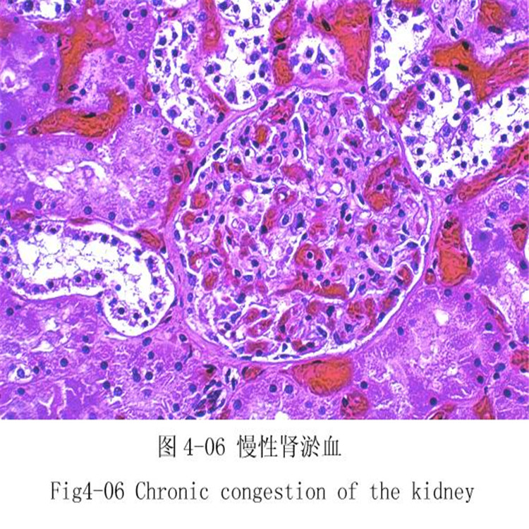 慢性腎淤血